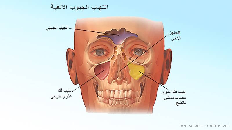 هل الجيوب الأنفية تسبب تغير الصوت؟ اكتشف الحقيقة وراء هذا العارض