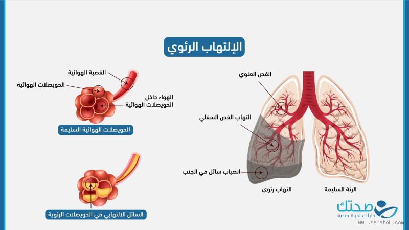 كيف أعرف أن الرئة ملتهبة؟