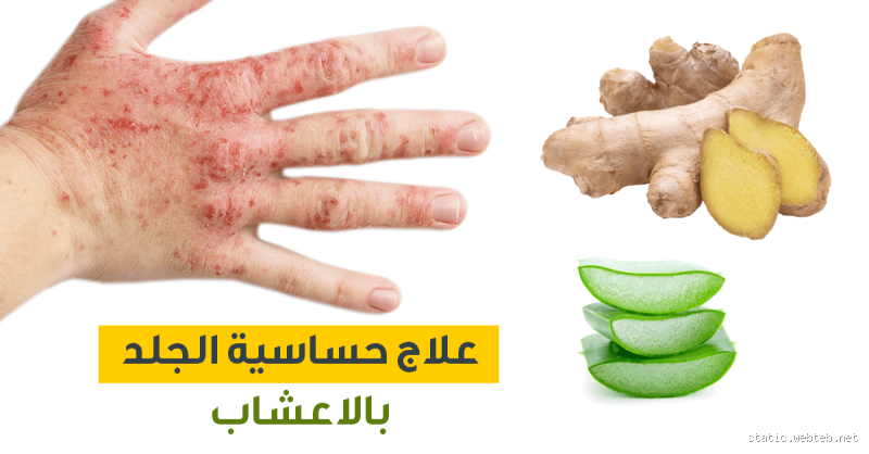 ما هو علاج الحساسية والحكة؟